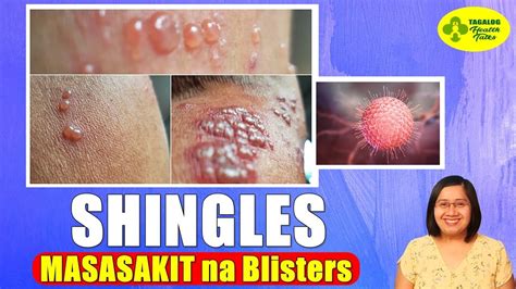 Shingles Meaning In Telugu